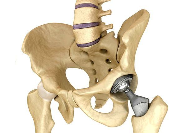 Endoprostics of the hip joint