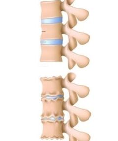 The causes of osteochondrosis