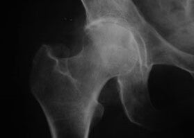 X-ray of the hip joint with osteoarthritis.