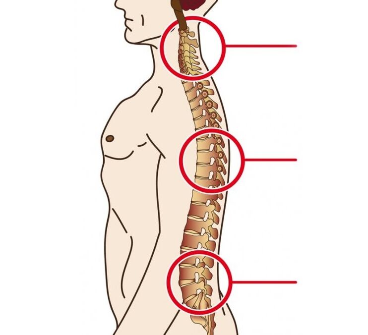 Location of cervical, thoracic and lumbar osteochondrosis.