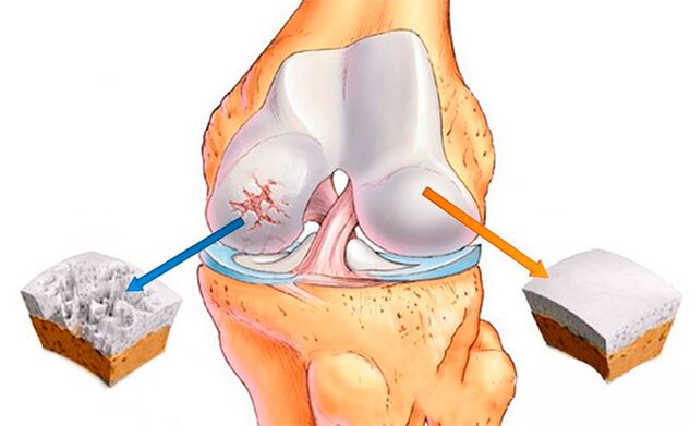 A normal knee joint (right) and another affected by osteoarthritis (left)