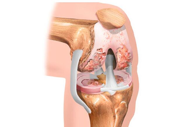Athrosis of the knee joint.