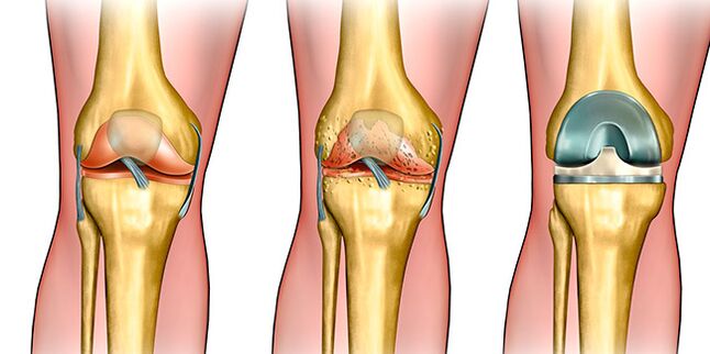 In the third stage of osteoarthritis, knee replacement is required.
