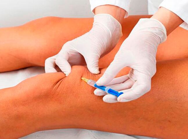 Intra-articular injections of drugs for osteoarthritis of the knee joint.