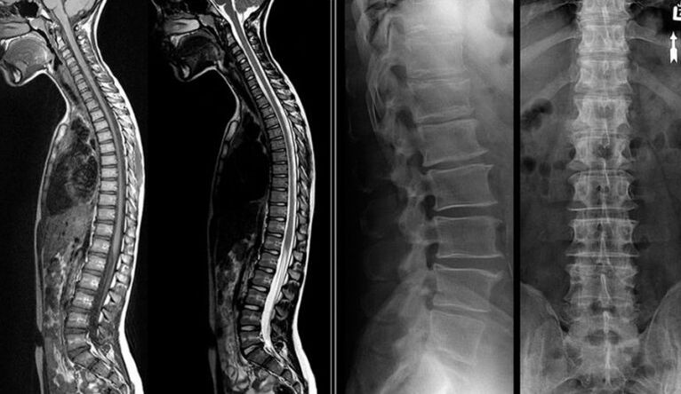 X-ray and MRI imaging for osteochondrosis