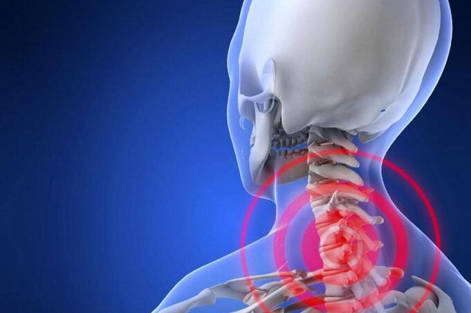 Stabbing pain in the neck an early symptom of cervical osteochondrosis