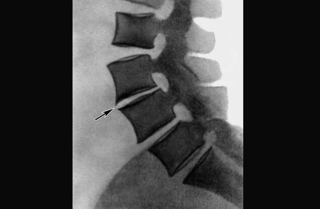 Manifestations of osteochondrosis of the thoracic spine on the radiograph. 