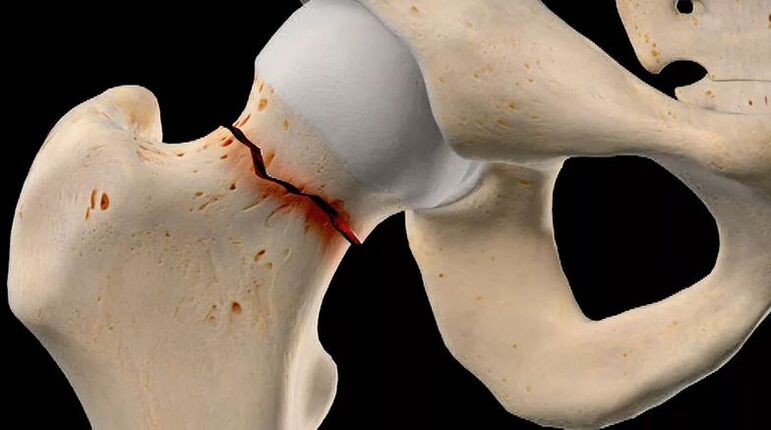 Femoral neck fracture is one of the causes of secondary coxarthrosis. 