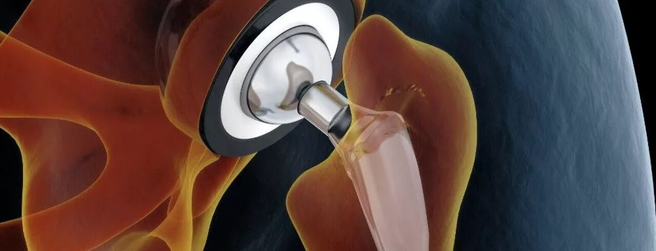 Hip joint endoprosthesis in last degree coxarthrosis