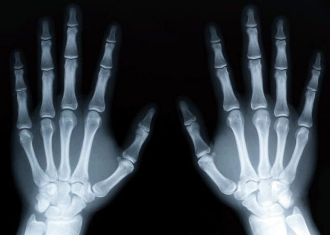 Gout causes the development of gouty arthritis, which can be diagnosed by x-ray. 